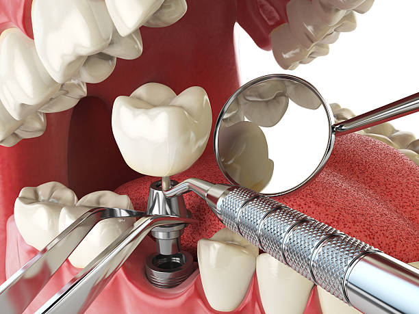 Urgent Tooth Repair in OH